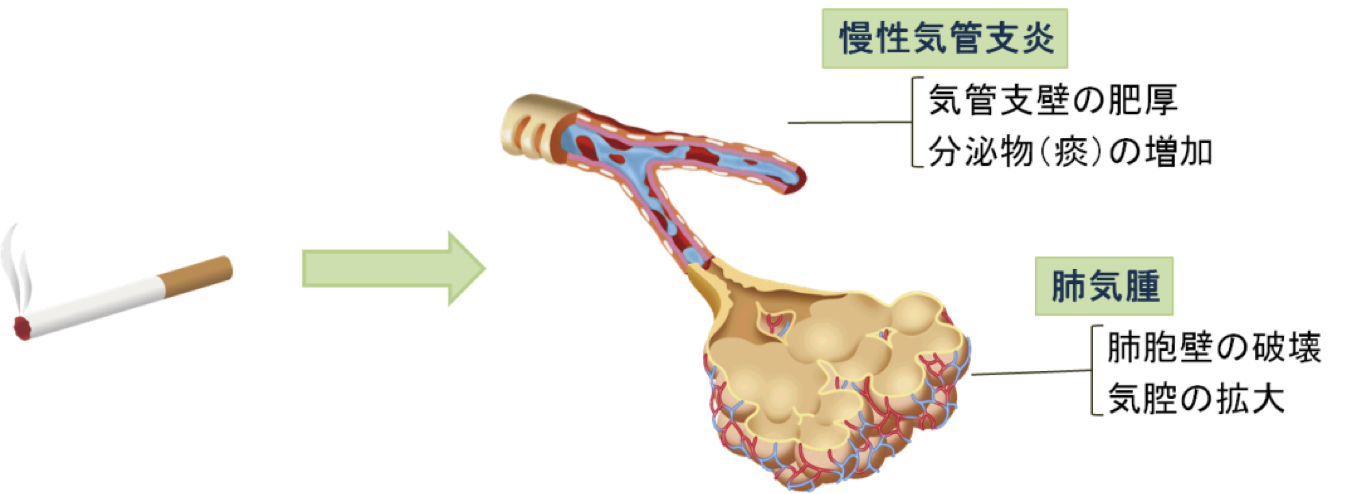 初期 症状 肺気腫