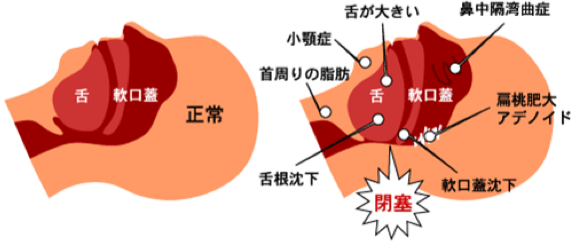 睡眠時無呼吸症候群