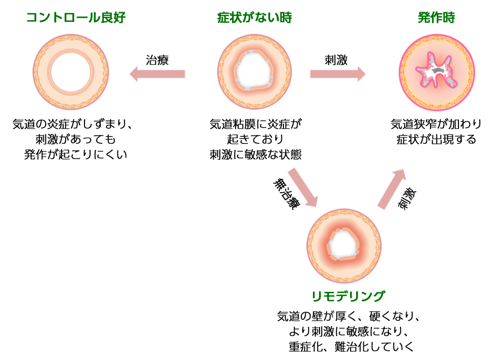 気管支ぜんそく